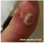 Orf virus on fingertip